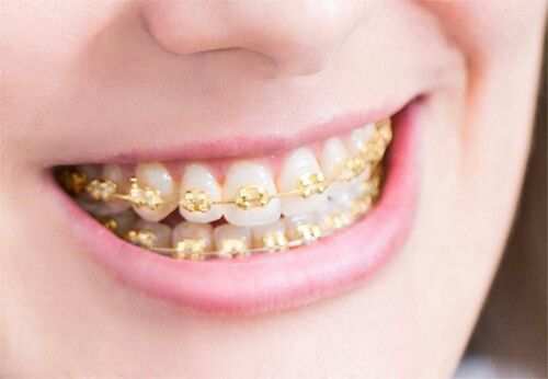 Golden Braces