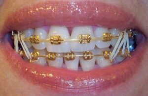 Golden Braces